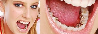 What are Lingual Braces?