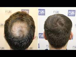 Hair loss or alopecia is a common and distressing clinical complaint in the primary care setting and can arise from heterogeneous etiologies. Fue Hair Transplant 1850 Fue Grafts In Crown Vertex By Dr Couto Fuexpert Clinic Madrid Spain Youtube