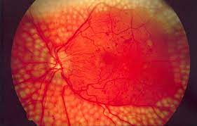 Healthy people 2020 sets national objectives to improve eye health and uses data to track progress toward these goals. Diabetic Retinopathy Wikipedia