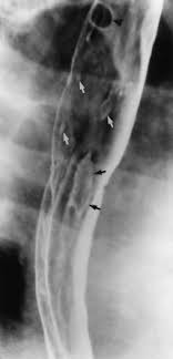 Epidemiology the actual incidence and prevalence of idiopathic esophagitis of hiv are unknown. References In Barium Studies Gastrointestinal Endoscopy