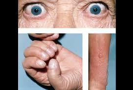 It frequently results in and is the most common cause of hyperthyroidism. Graves Disease Picture Image On Medicinenet Com