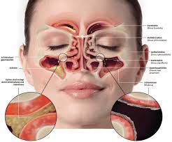Nasennebenhohlenentzundung Rhinosinusitis Symptome