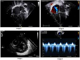Image result for Delayed Transition from Fetal Circulation