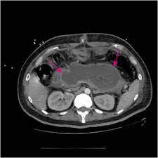 A pancreatite aguda é uma inflamação aguda do pâncreas. Pancreatite Aguda Disturbios Gastrointestinais Manuais Msd Edicao Para Profissionais