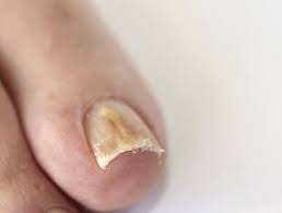 Image result for Yellow nail syndrome feet
