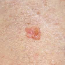 Mamelak, md, a board certified dermatologist and founder of sanova dermatology in austin, tx. What Does Squamous Cell Cancer Look Like