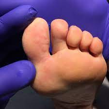 Toe cramps can have a variety of causes. Plantar Warts One Foot Clinic