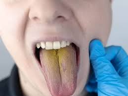 Image result for yellow tongue infection