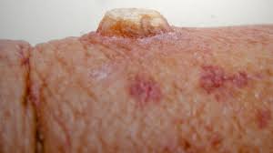 Image result for cornu cutaneum)