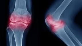 Image result for what is the treatment for subchondral sclerosis