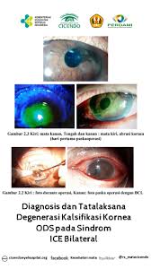 Kornea nedir sorusunu göz hastalıkları uzmanı doç. Cicendo Eye Hospital