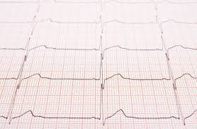Sinus Heart Rhythm On Electrocardiogram Record Papershowing