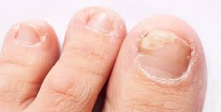 Image result for mykoza nehtů