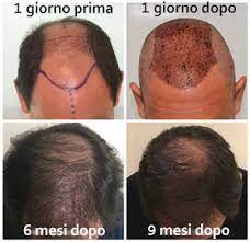 L'intervento di autotrapianto dei capelli viene eseguito in anestesia locale accompagnata da sedazione. Miti E Bugie Sul Trapianto Di Capelli