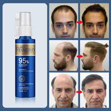 Minoxidil solution and foam are used to help hair growth in the treatment of male pattern baldness. 3pcs Hair Growth Oil Treatment Anti Hair Loss Men Beard Growth Oil Topical Solutions Repair Damage Hair Roots Hair Care Products Hair Loss Products Aliexpress
