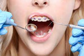 Many orthodontists use an early set of braces to expand the upper jaw and try to make the teeth straighter during younger years of a patient's life. What S The Best Age To Get Braces Thomas Orthodontics