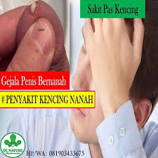 Obat Tradisional Untuk Kencing Nanah