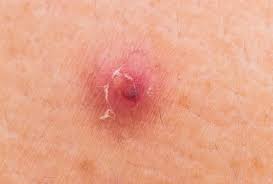 How do i distinguish a regular ingrown hair from a bad one after brazilian wax? Why You Should Never Pop Zits Ingrown Hairs And Other Bumps Men S Health