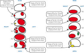 The accuracy of diagnosis for higher grade prostate cancer was similar for immediate biopsy vs. Multiparametric Mri In Prostate Cancer Cancer World Archive