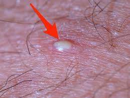 Shaving is the biggest culprit for triggering ingrown hairs, this is because 'when the hair grows back, it has a sharper edge and can easily poke back into the skin'. How To Get Rid Of Ingrown Hairs