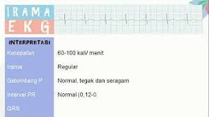 Calibrasi normal calibrasi adalah 1mv (10 kotak kecil / 2 kotak besar). Interpretasi Ekg Youtube