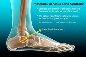 Symptoms Of Sinus Tarsi Syndrome Sinusitis Treatment Recovery Symptoms