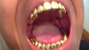 Jaffe strikes gold (teeth, that is). Ultimate Guide For Permanent Gold Teeth Updated