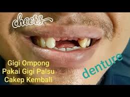 Membawa anak untuk kunjungan ke dokter gigi seringkali menjadi tantangan tersendiri. Pasang Gigi Palsu Lepasan Cowok Ini Kembali Tersenyum Lebar Youtube