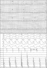 Président du groupe espírito santo , il était, jusque juillet 2014, le plus ancien banquier en activité au. 1 1 Atrial Flutter After Vernakalant Administration For Atrial Fibrillation Cardioversion Revista Espanola De Cardiologia