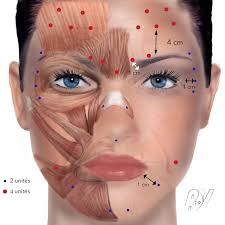 Absorbée en quantité, peut causer le botulisme, une. Toxine Botulique Les Ateliers Du Visage