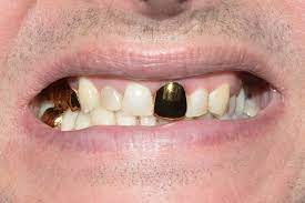 In canada and australia, the price is around the us price. What S A Smile Worth The Pros And Cons Of Gold Teeth Implants