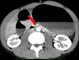 Acute Abdominal Pain Caused By Superior Mesenteric Artery Syndrome In A Healthy Young Boy Bmj Case Reports