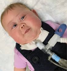 Respiratory Symptoms