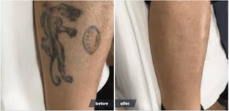 What's the relation between tattoos and mental health? The Laser Tattoo Removal Healing Process Removery