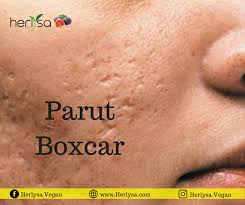 Parut Boxcar Ni Jenis Parut Jerawat Yang Biasanya Berbentuk Bulat Atau Bujur Dengan Sisi Sudut Yang Tajam Di Dalam Kulit Parut Ni Na Movie Posters Movies