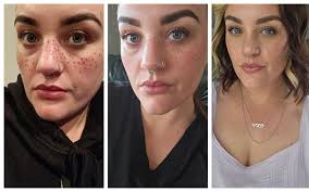 Why are people getting freckles tattooed?