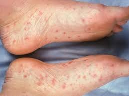 Here are the symptoms and treatment for the condition. Foot Rash Causes Symptoms Treatment