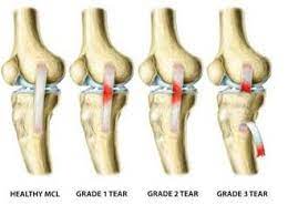 Grade 2 grade 2 acl injuries are rare and describe an acl that is stretched and partially torn. Nrl Physio On Twitter James Maloney To Return This Weekend 3 Weeks After Suffering A Grade 2 Mcl Injury One Of The Quicker Recoveries In Recent Times This Injury Involves A Partial