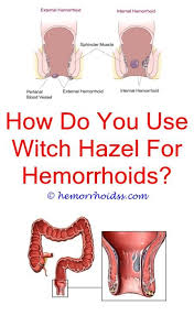 Do Hemorrhoid Flare Ups Go Away How To Know If I Have Internal Or External Hemorrhoids Why Ca Bleeding Hemorrhoids Hemorrhoids Treatment Cure For Hemorrhoids