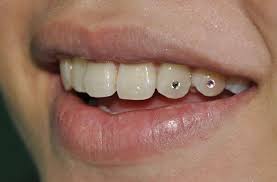 So many names for different types of teeth jewelry, a retro trend that everyone is hopping on at the moment. The Dangers Of Tooth Gems Stensland Dental Studio