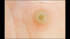 Rein äusserlich betrachtet ist die komplette grösse der dornwarze nicht festzustellen. Warze Beim Kind Ansteckungsorte Und Behandlungsweisen