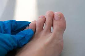 Image result for Onycholysis feet