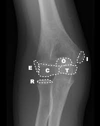 Image result for Lateral Condyle Fracture