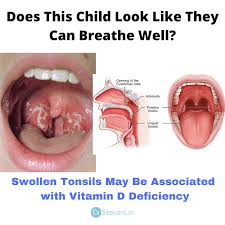 ✓ free for commercial use ✓ high quality images. Dr Steven Lin The Development Of Young Child S Brains Are Dependent On Sleep When Airway Obstructions Occur During Sleep A Child S Brain Is Sent Into A Choking Response One Aspect That