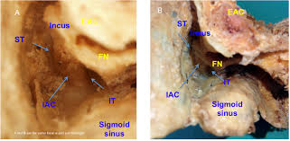 Temporal Bone Anatomy Cadaveric Dissection Iowa Head And Neck Protocols