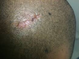 Your scalp is covered in hair follicles, tiny sacs from which each strand of hair grows. Will My Hair Grow Back After Getting Scalp Cysts Surgically Removed Photo