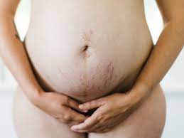 5 Ways To Get Rid Of Stretch Marks - Today's Parent