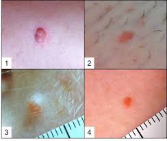 We did not find results for: Bap1 Cancer Syndrome Malignant Mesothelioma Uveal And Cutaneous Melanoma And Mbaits Springerlink