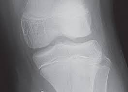 Image result for Segond Fracture