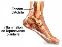 Traitements le retour à la normale est long et progressif car c'est un tendon de taille importante. Lesions De L Aponevrose Plantaire Le Grand Ouille Runners Fr